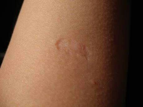 Ha van egy ilyen heg a válladon, az nem hiába került oda. EZ a jelentősége: