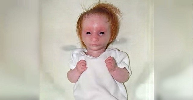 Porcelánbabára hasonlított, amikor világra jött. 5 év telik el, és még az orvos sem hisz a szemének!