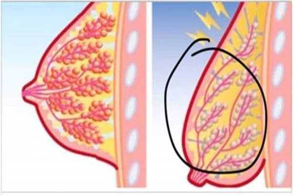 Ez a valódi oka a mellek megereszkedésének és megmutatjuk, mit tehetsz ellene!