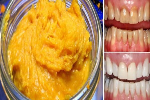 Mióta ezt a házi fogkrémet használom, hófehérré varázsolta a fogaimat és megszüntette a gyulladást!