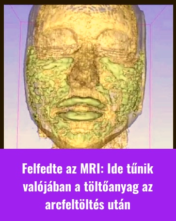 Felfedte az MRI: Ide tűnik valójában a töltőanyag az arcfeltöltés után