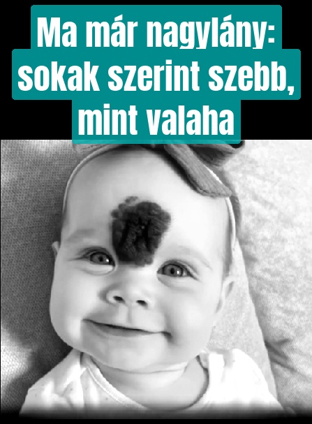 A szülők leszedetik kislányuk különleges anyajegyét, hogy megóvják őt a szekálástól