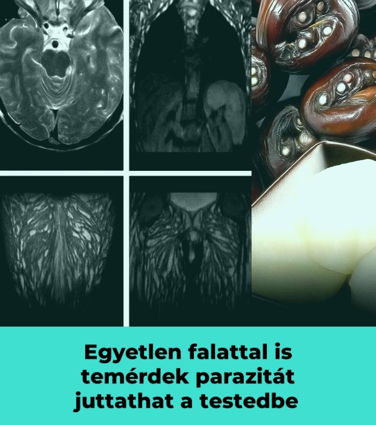 Egyetlen falattal is temérdek parazitát juttathat a testedbe