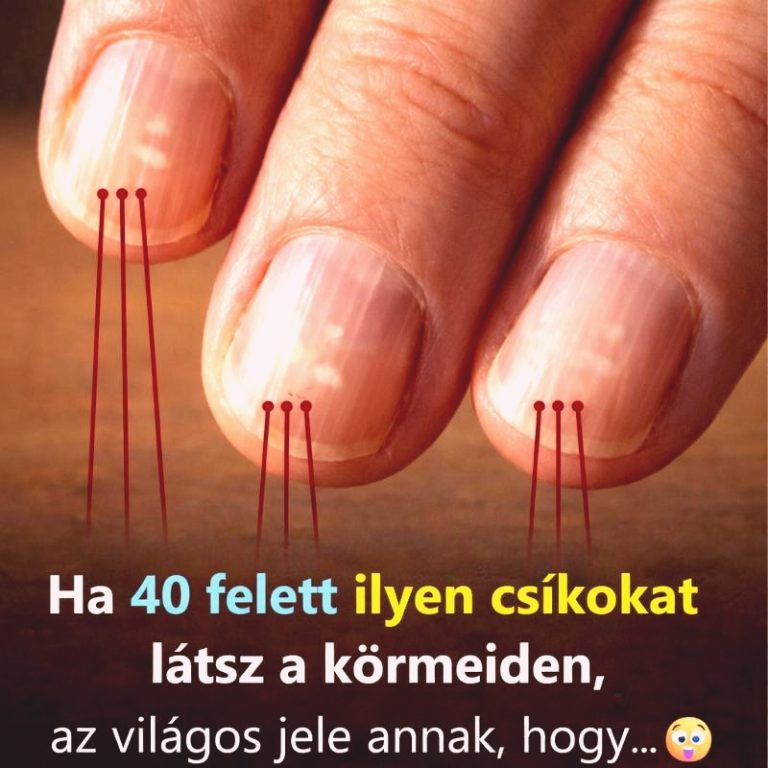 Ha 40 év felett ilyen vonalakat látsz a körmödön, az erős jelzés lehet 🤔