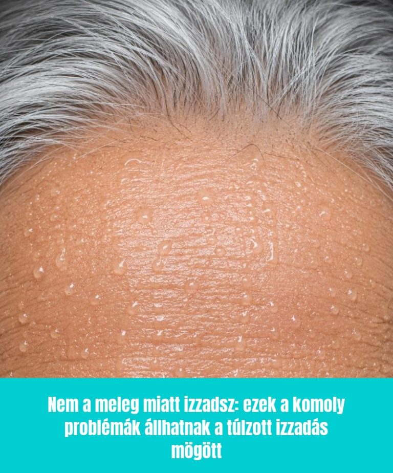 Nem a meleg miatt izzadsz: ezek a komoly problémák állhatnak a túlzott izzadás mögött